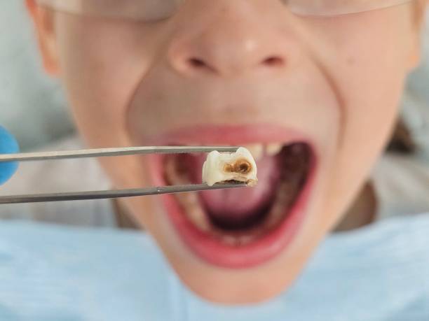 Best Emergency Treatment for Toothache in Adel, GA